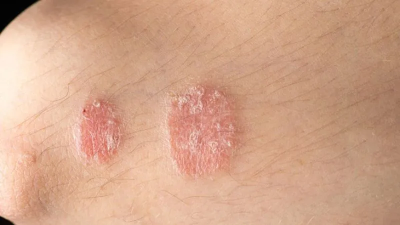 tinh dầu mùi tây giúp làn da mờ thâm, kháng nấm do vi khuẩn gây ra