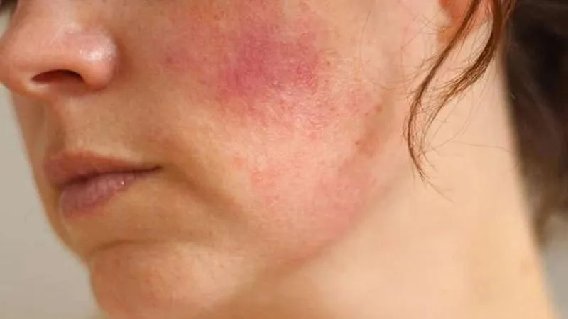 Rau kinh giới giúp hồi phục làn da bị dị ứng hiệu quả, an toàn