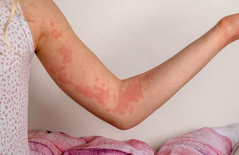 Ngải cứu tươi có thể giã nhuyễn đắp lên vết ngứa, mụn nhọt để kháng viêm