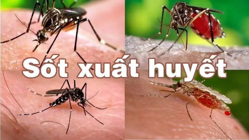 Sốt xuất huyết do một loại siêu vi trùng tên Dengue gây ra