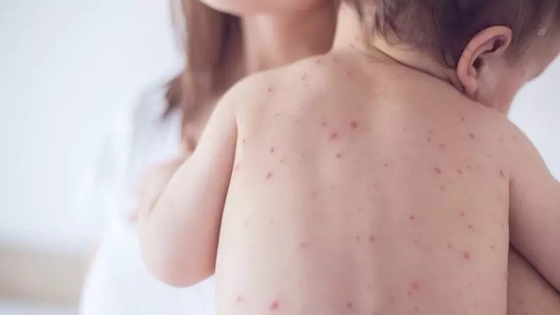 Đây là mức độ nặng nhất của bệnh sốt xuất huyết
